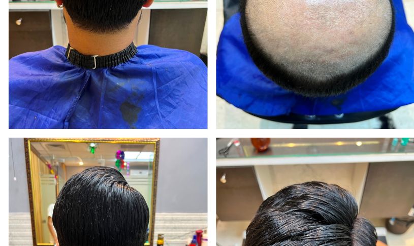Hair Patch in Ghaziabad