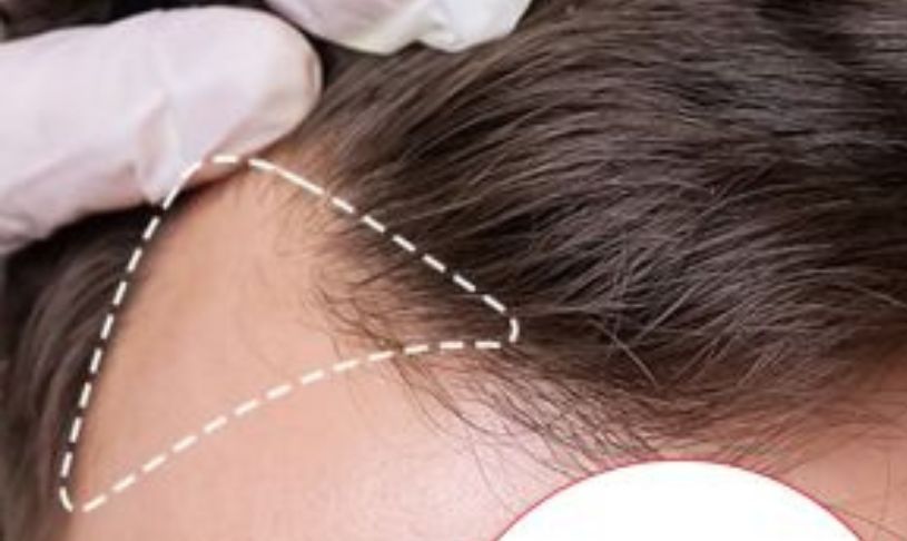 Hair Patch in Greater Noida (1)