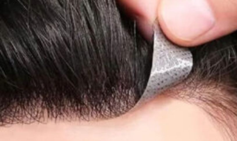 Hair Patch in Gurgaon