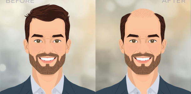 Hair Transplant in Indore