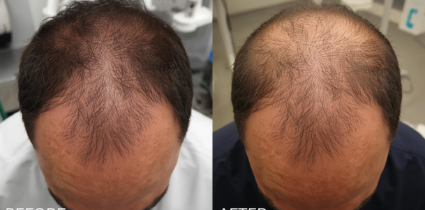 Hair Transplant in nagpur