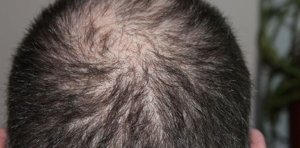 Hair Transplant in Bareilly