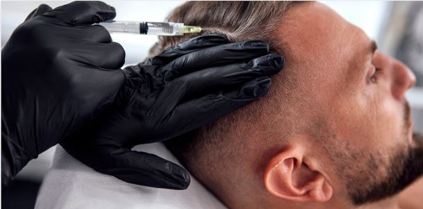 Top Hair Transplant in Muzaffarnagar