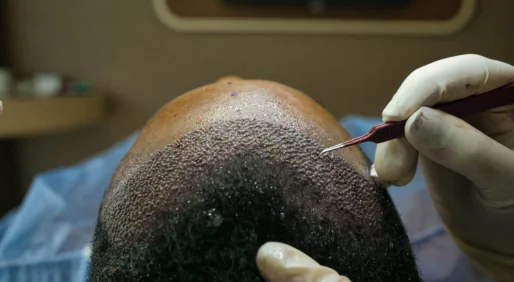 DHT Hair Transplant