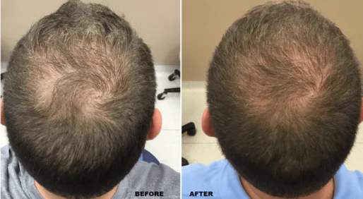 FUT Hair Treatment