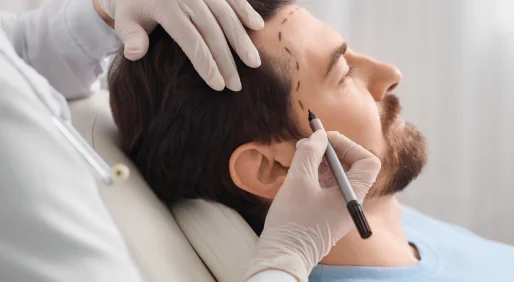 Hair Transplantation
